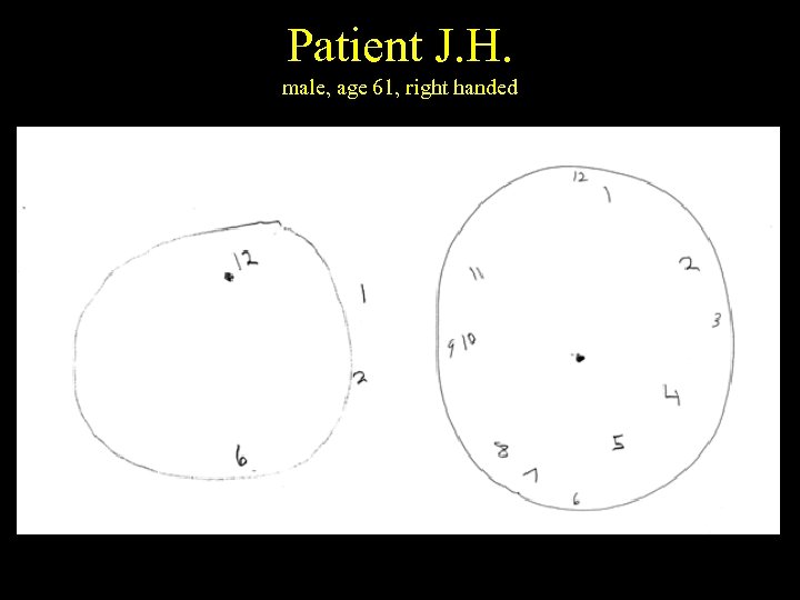 Patient J. H. male, age 61, right handed 