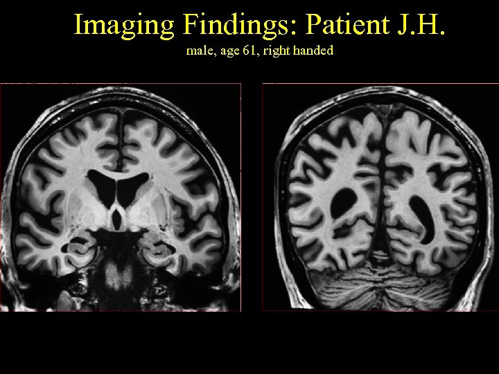 Imaging Findings: Patient J. H. male, age 61, right handed 