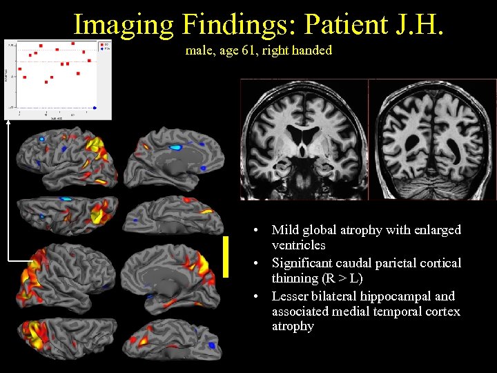 Imaging Findings: Patient J. H. male, age 61, right handed • Mild global atrophy