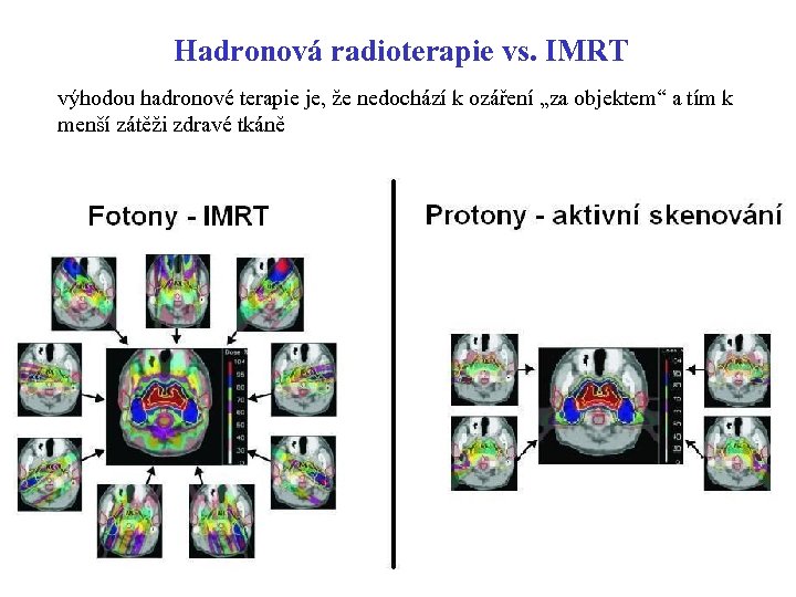 Hadronová radioterapie vs. IMRT výhodou hadronové terapie je, že nedochází k ozáření „za objektem“