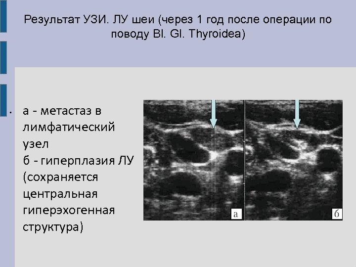 Узи лимфоузлов шеи ребенку