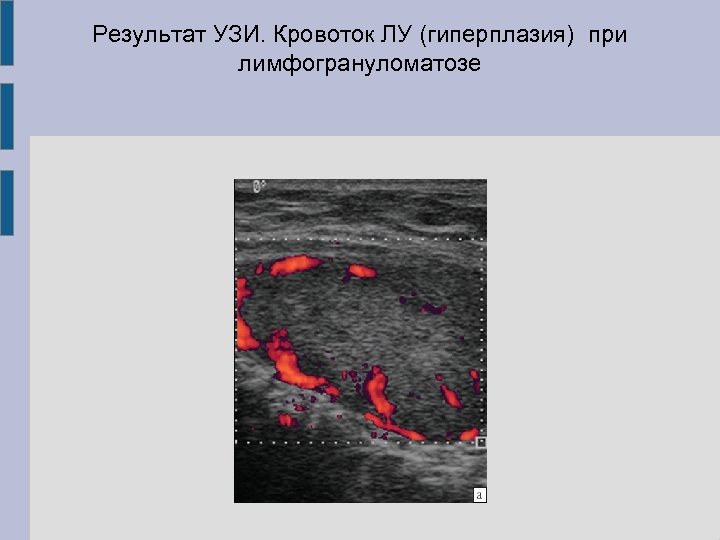 Результат УЗИ. Кровоток ЛУ (гиперплазия) при лимфогрануломатозе 