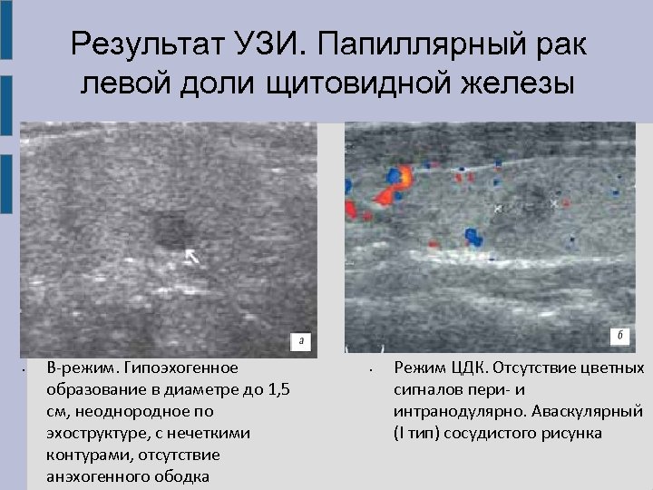 В режиме цдк сосудистый рисунок усилен