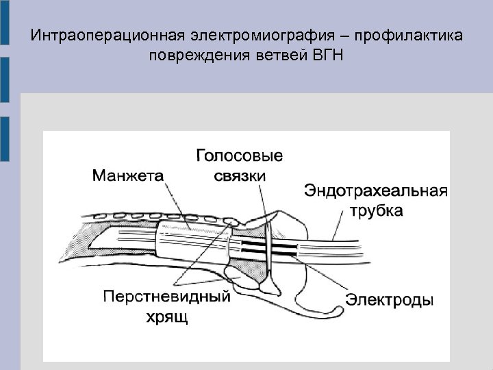 Интраоперационная электромиография – профилактика повреждения ветвей ВГН 