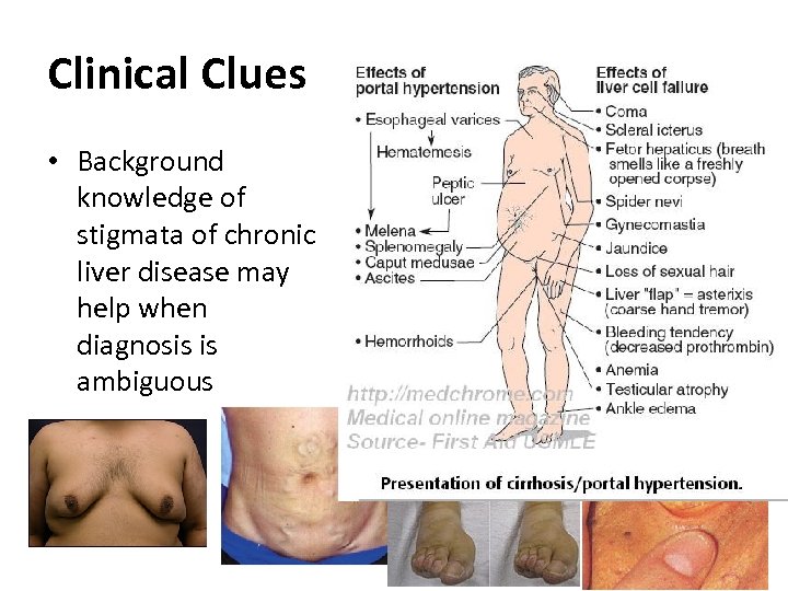 Clinical Clues • Background knowledge of stigmata of chronic liver disease may help when