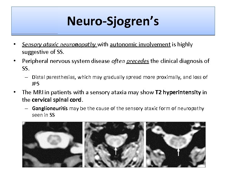 Neuro-Sjogren’s • Sensory ataxic neuronopathy with autonomic involvement is highly suggestive of SS. •