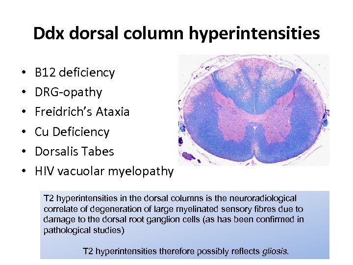 Ddx dorsal column hyperintensities • • • B 12 deficiency DRG-opathy Freidrich’s Ataxia Cu