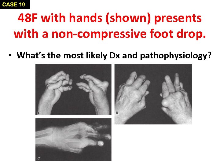 CASE 10 48 F with hands (shown) presents with a non-compressive foot drop. •