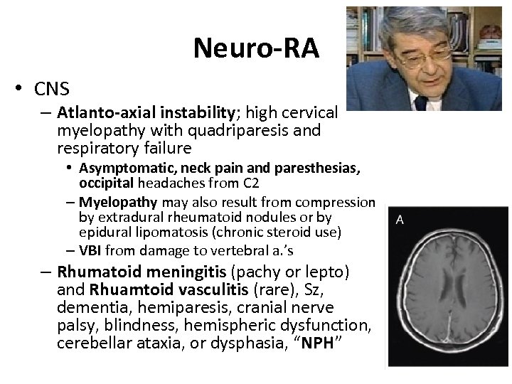 Neuro-RA • CNS – Atlanto-axial instability; high cervical myelopathy with quadriparesis and respiratory failure