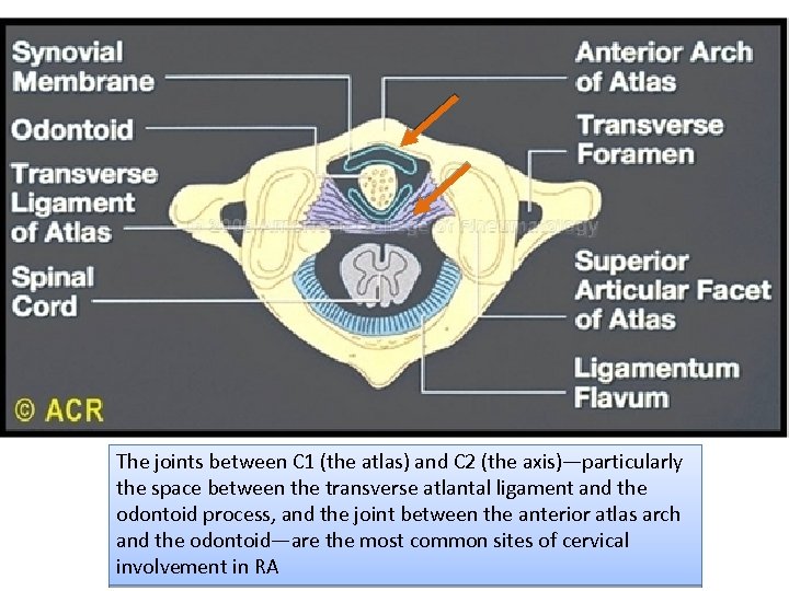 The joints between C 1 (the atlas) and C 2 (the axis)—particularly the space