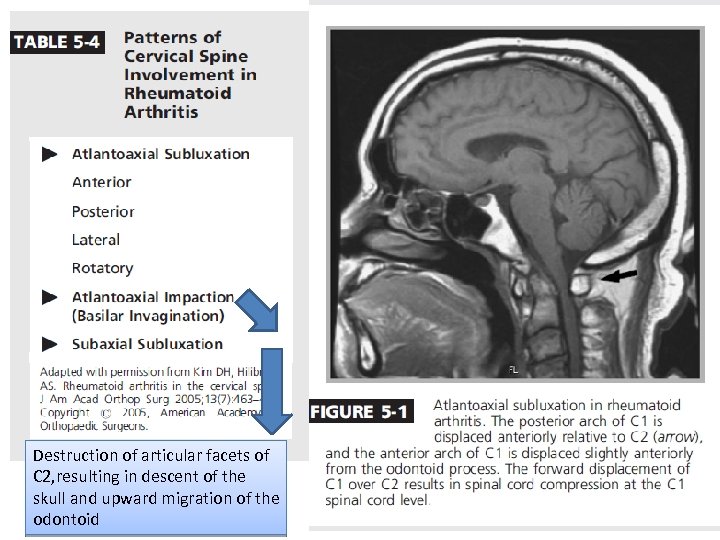 Destruction of articular facets of C 2, resulting in descent of the skull and