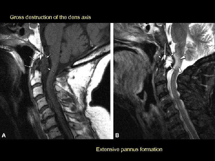 Gross destruction of the dens axis Extensive pannus formation 