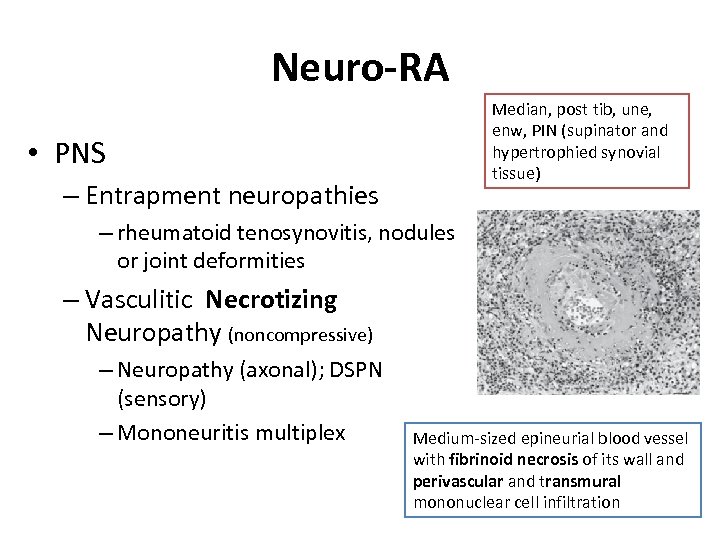 Neuro-RA Median, post tib, une, enw, PIN (supinator and hypertrophied synovial tissue) • PNS