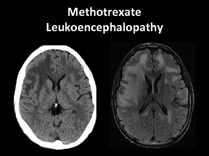 Methotrexate Leukoencephalopathy 