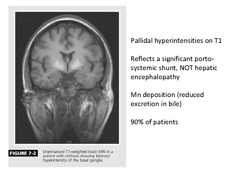 Pallidal hyperintensities on T 1 Reflects a significant portosystemic shunt, NOT hepatic encephalopathy Mn