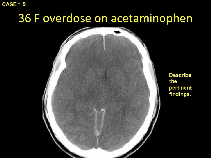 CASE 1. 5 36 F overdose on acetaminophen Describe the pertinent findings. 