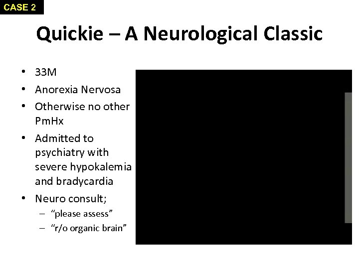 CASE 2 Quickie – A Neurological Classic • 33 M • Anorexia Nervosa •