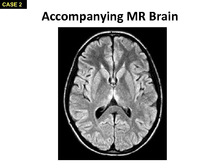 CASE 2 Accompanying MR Brain 