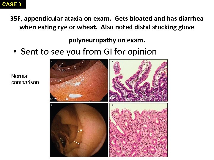 CASE 3 35 F, appendicular ataxia on exam. Gets bloated and has diarrhea when