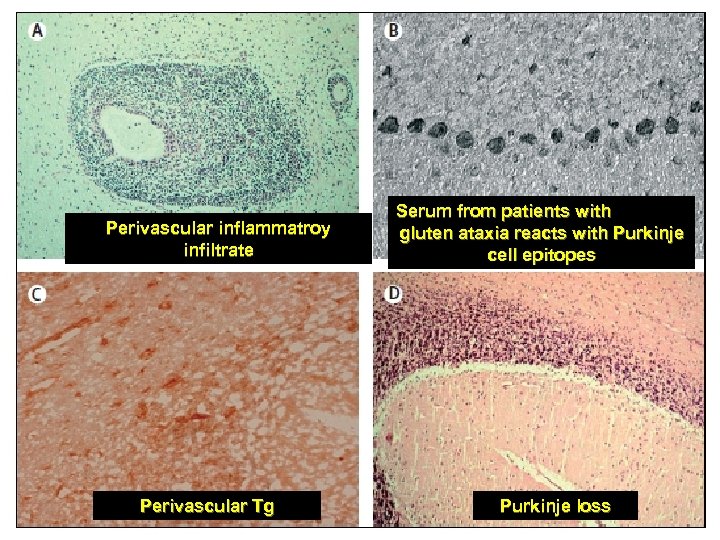 Perivascular inflammatroy infiltrate Perivascular Tg Serum from patients with gluten ataxia reacts with Purkinje