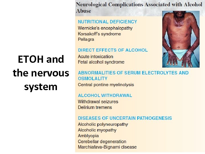 ETOH and the nervous system 