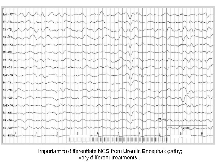 Important to differentiate NCS from Uremic Encephalopathy; very different treatments. . . 