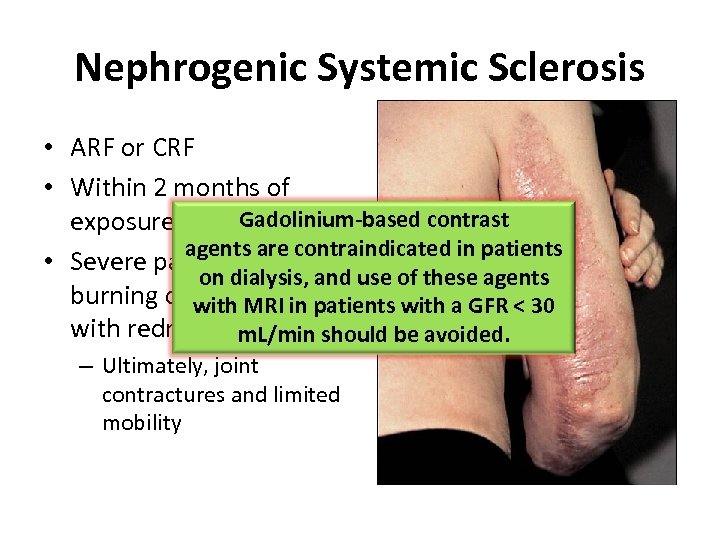 Nephrogenic Systemic Sclerosis • ARF or CRF • Within 2 months of exposure to