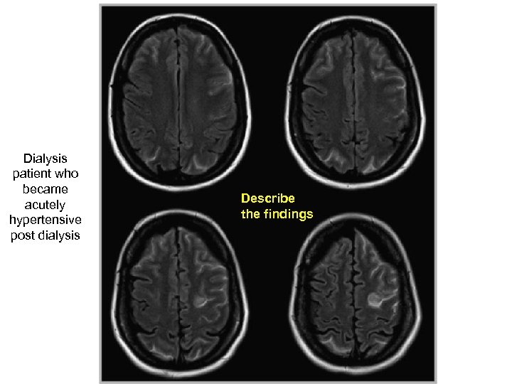 Dialysis patient who became acutely hypertensive post dialysis Describe the findings 