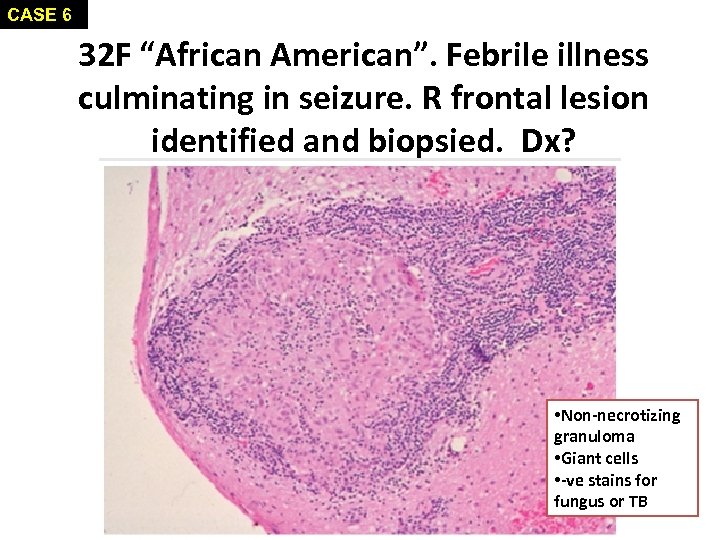 CASE 6 32 F “African American”. Febrile illness culminating in seizure. R frontal lesion