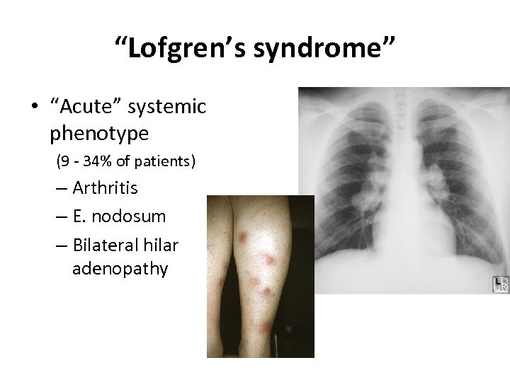 “Lofgren’s syndrome” • “Acute” systemic phenotype (9 - 34% of patients) – Arthritis –