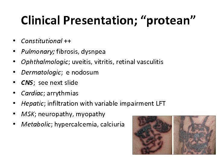 Clinical Presentation; “protean” • • • Constitutional ++ Pulmonary; fibrosis, dysnpea Ophthalmologic; uveitis, vitritis,