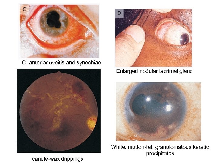 C=anterior uveitis and synechiae Enlarged nodular lacrimal gland candle-wax drippings White, mutton-fat, granulomatous keratic