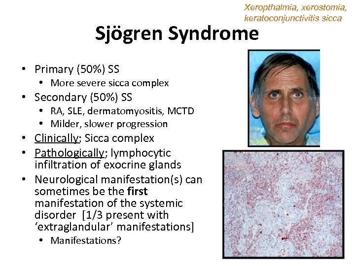 Xeropthalmia, xerostomia, keratoconjunctivitis sicca Sjögren Syndrome • Primary (50%) SS • More severe sicca