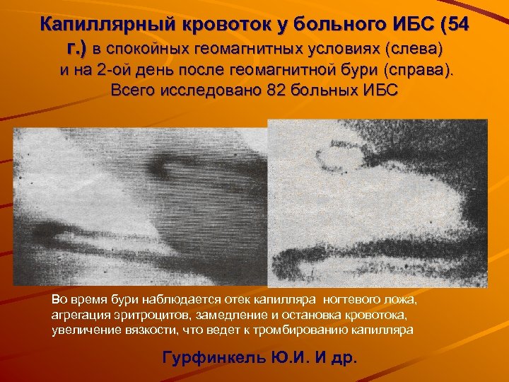 Капиллярный кровоток у больного ИБС (54 г. ) в спокойных геомагнитных условиях (слева) и