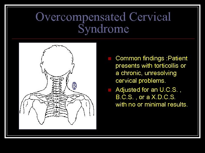 Overcompensated Cervical Syndrome n R n Common findings : Patient presents with torticollis or
