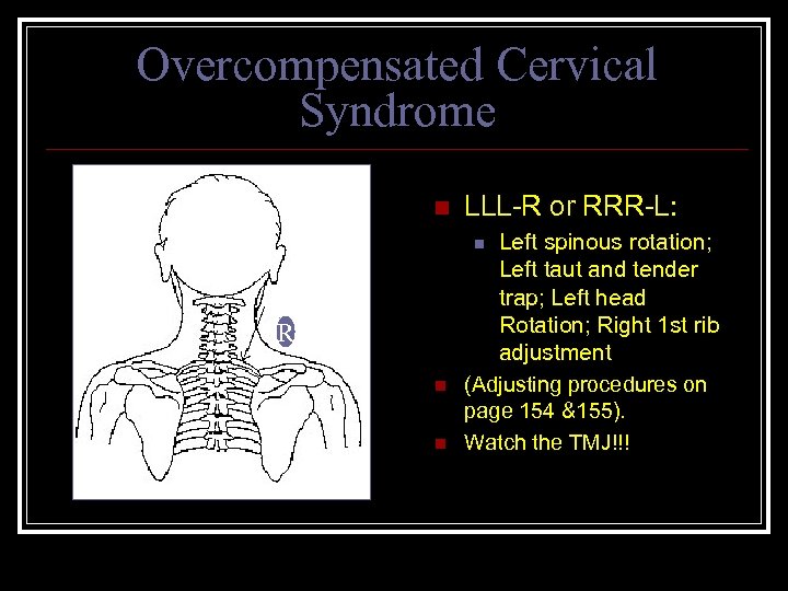 Overcompensated Cervical Syndrome n LLL-R or RRR-L: Left spinous rotation; Left taut and tender