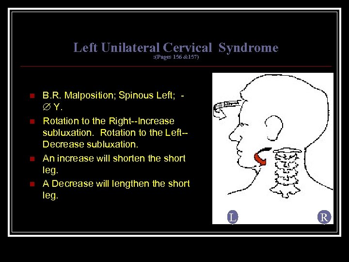Left Unilateral Cervical Syndrome : (Pages 156 &157) n n B. R. Malposition; Spinous