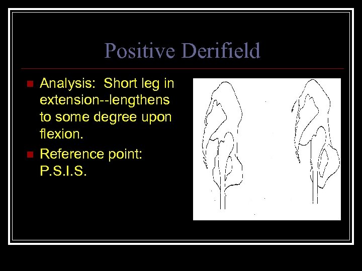 Positive Derifield n n Analysis: Short leg in extension--lengthens to some degree upon flexion.