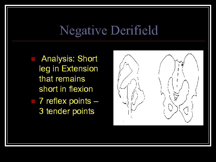 Negative Derifield n n Analysis: Short leg in Extension that remains short in flexion