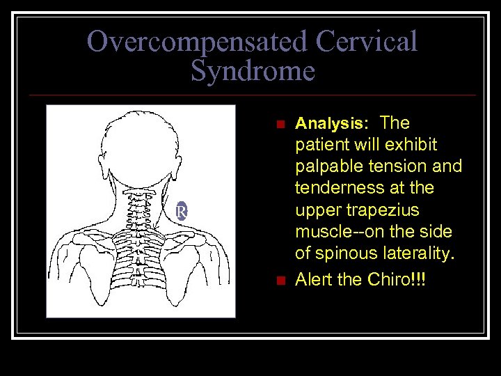 Overcompensated Cervical Syndrome n Analysis: The n patient will exhibit palpable tension and tenderness