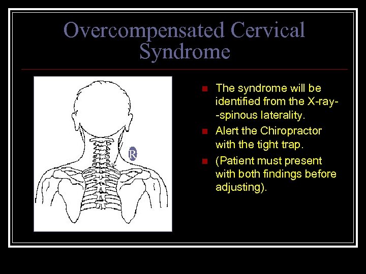 Overcompensated Cervical Syndrome n n R n The syndrome will be identified from the