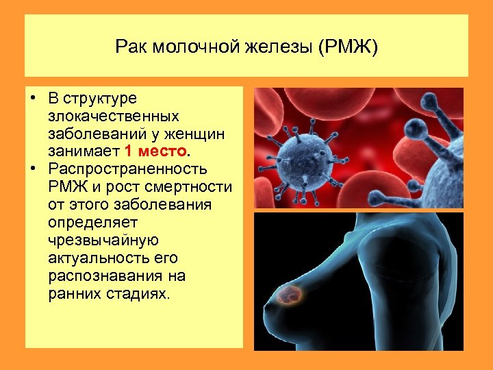 Рак молочной железы (РМЖ) • В структуре злокачественных заболеваний у женщин занимает 1 место.