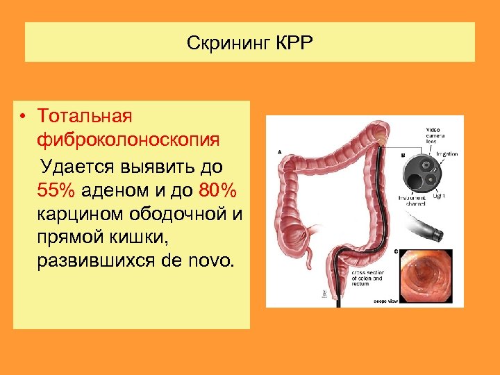 Скрининг КРР • Тотальная фиброколоноскопия Удается выявить до 55% аденом и до 80% карцином