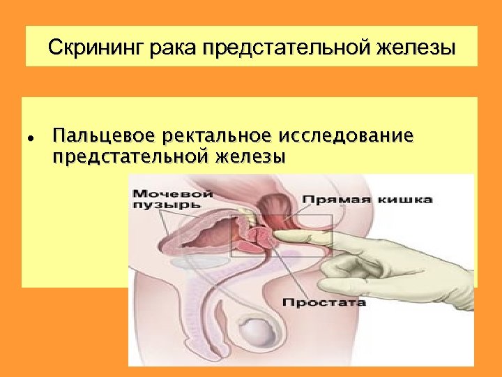 Скрининг рака предстательной железы Пальцевое ректальное исследование предстательной железы 