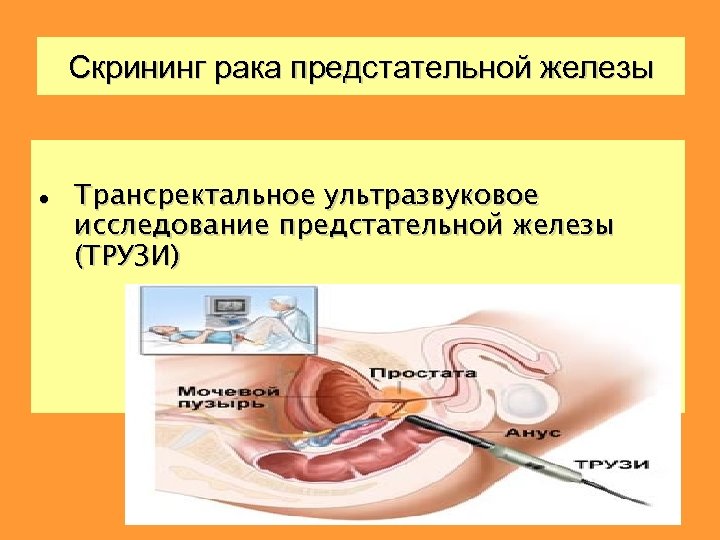 Скрининг рака предстательной железы Трансректальное ультразвуковое исследование предстательной железы (ТРУЗИ) 