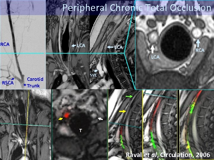 Peripheral Chronic Total Occlusion RCA LCA RSCAD SVC Carotid Trunk T Raval et al,