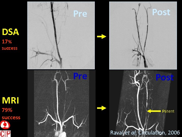Pre Post DSA 17 % success Pre Post MRI 79% success Patent Raval et
