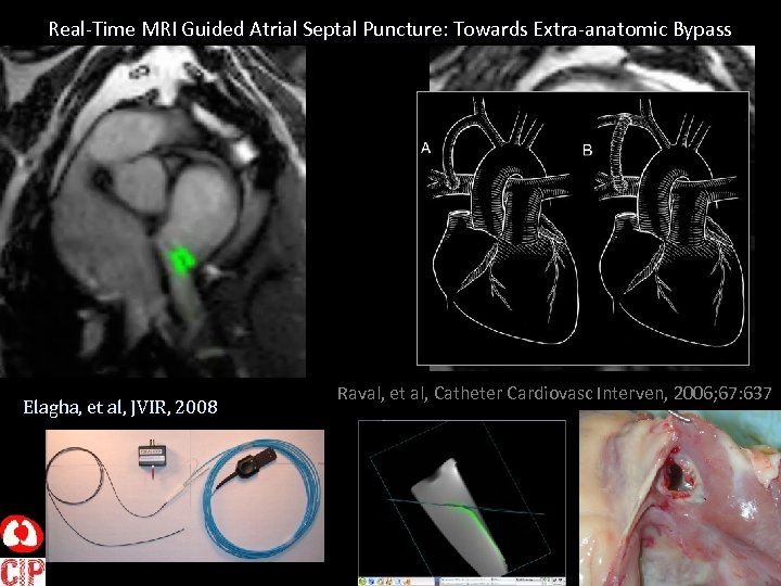 Real-Time MRI Guided Atrial Septal Puncture: Towards Extra-anatomic Bypass Elagha, et al, JVIR, 2008