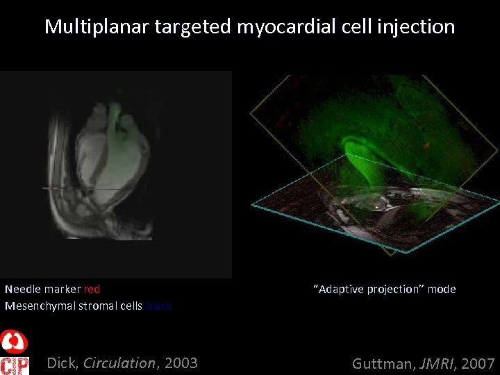 Multiplanar targeted myocardial cell injection Needle marker red Mesenchymal stromal cells black Dick, Circulation,