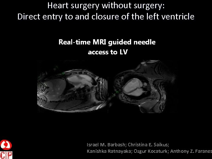 Heart surgery without surgery: Direct entry to and closure of the left ventricle Israel